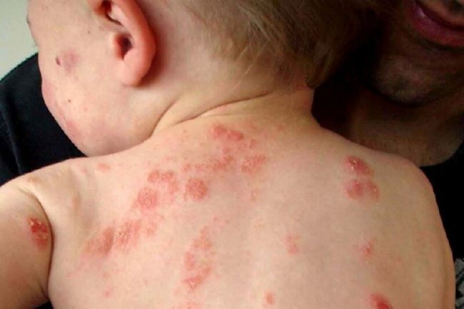Viêm da cơ địa ở trẻ em